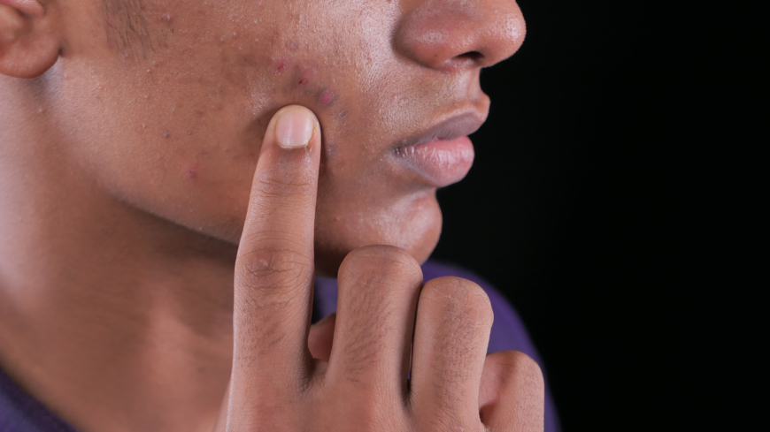 Hyperpigmentering kan lämna mörka fläckar svåra att behandla. Foto: Getty Images
